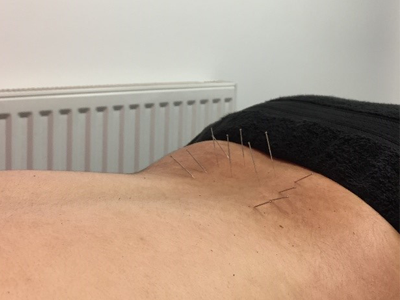 Dry needling